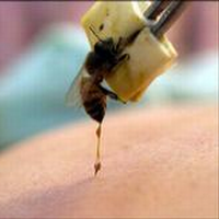 العلاج بسم النحل , العلاج بلدعات النحل , العلاج بقرص النحل Apitherapy-The-Bee-Venom-Therapy-3